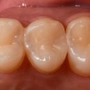 RPD치과기공소 이미지