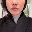 신사한의원 | [후기] 신사역 한의원 새살침 코모공축소시술 가격