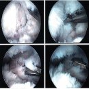 [관절내시경, 무릎연골수술] 연골판파열, 십자인대파열, 십자인대수술 이미지