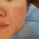 이유한의원 | 부산흉터치료 새살침 받은 후기 여드름흉터한의원 좋았던 이유