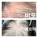 탈모왕 | 대구SMP아카데미 대구두피 SMP가격 탈모왕 대구점