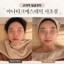 아나 피부샵 | 교대역 얼굴경락 내돈내산 후기, 비대칭 고민으로 찾은 아나티크에스테틱 서초점