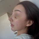 오투약국 | 부산 기능코+미용코 수술후기 (1) 당일~7일차