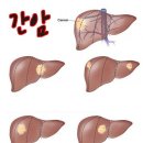 간암수술 2. 간암절제술 [간암] 이미지