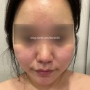 [신부관리] 강남역 에스테틱 공간 데콜테 &amp; F.M 쿨링 초음파 후기(홍정화 선생님)