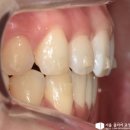 서울클리어치과교정과치과의원 | 성북구 치과 윗니 돌출과 삐뚤 빼뚤한 아랫니 교정 인비절라인 개선 과정 케이스