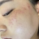 대전잡티제거 대전 주근깨제거 힙티크에서 받은 후기