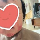 아주대학병원 | [경험담]아기 아토피 극복기 2탄 ~ing (feat.아주대학병원, 알레르기 검사 채혈 후기)