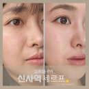 SMF 시스템 | 신사역피부과 피부 정밀진단 가능한 피부과 세르프 통증 300샷 후기