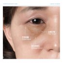 예미원피부과의원 | 예미원피부과 10가지 형태별 눈밑지방 유형과 최신 눈밑지방재배치 시술 방법