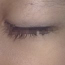 세종바름약국 | 약국 비립종 연고 고르는 방법 효과는