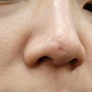도봉제일한의원 | 의정부흉터치료 긁힌흉터 새살침 6회차 리뷰