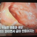 소장을 뒤덮은 염증과 궤양, 굴이 만들어지는 크론병 이미지