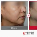 티나성형외과의원 네이버블로그