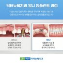 선진치과의원 | 서초역 임플란트 치과 앞니 임플란트로 고민한다면 선택 조건