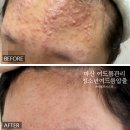 미엘르네일 | 마산여드름관리 청소년 여드름 압출 미엘르지스킨 추천