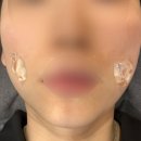 쁘띠비쥬 | 청담동리프팅 리프테라로 심부볼 탄력 관리 받고 왔어요