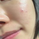 바이차이주 | 부산 여드름 흉터치료 1회차 10일 후 솔직 후기 ✍️ 흉터피부과 새살침 효과, 관리 팁!