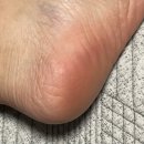 화랑약국 | 발바닥무좀 연고재발했던 이유 완치 후기