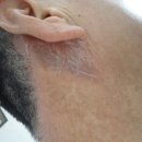 지루성 피부염 치유, 개선사례(사진 첨부) - 기린봉님 이미지