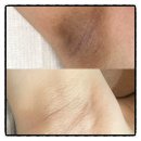 보정약국 | 겨드랑이 착색크림 올리브영 약국 착색크림 전부 비교해봄