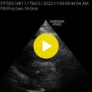 Degenerative annulus calcifications,MV 이미지