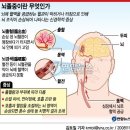 뇌졸중 이미지