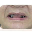 임플란트 재식립? 6개 이상 치료해야한다면 <필독>