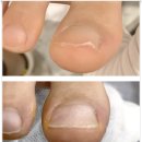 강서 마곡동 내성발톱 깔끔하게 해결 베티네일 내성발톱 무좀 발각질 문제성발