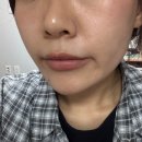 대구입술필러잘하는 곳 반월당성형외과 내돈내산 후기