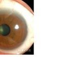 아이룩스 | 안과