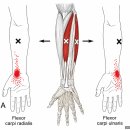 테니스엘보·골프엘보·손목·손가락 통증의 핵심! 전완굴근(Forearm Flexors) Trigger Point 풀기 이미지