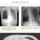 폐렴 초기 5가지 및 폐렴의 원인, 병원 방법 이미지