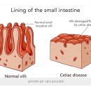 글루텐(gluten) 이미지