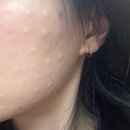 안아픈세상정웅기의원 | 서산 피부과 뷰티온의원 내돈내산 방문 찐후기 슈링크 보톡스 온다 피코토닝 후기(긴글주의)