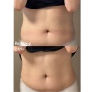 광주바로병원 | 광주다이어트병원 제로팻주사 후기｜복부지방분해주사 효과는?