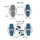 변형성 고관절증[Coxarthrosis] 근골격질환 이미지