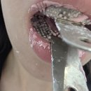 1331 | 드디어 끝이 보입니다! (거미스마일 &amp; 설소대 절제술 후기) (2025.10.23~2026.03.20) 교정1,331일째