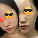극예민보스의 안산 물오른더예쁨 에스테틱 피부관리 솔직후기, 1년 지난 뒤 피부후기