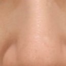 안경디렉터 | [내돈내산] 강남 디렉터의원 방문기 딱지레이저+피코토닝5회 최종후기