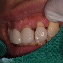 매니아치과기공소 | 잇몸 내려간 블랙트라이앵글 지르코니아 크라운 다시, 크라운 재치료