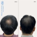 김천 상주 두피문신후기, 1년간 고민하고 상담받은 결과 최종 선택은?