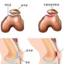 슬개건염, 슬개골 연골 연화증 (무릎 통증 염증) 이미지