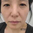 40대 피부탄력 고민으로 압구정 피부과 더프라이드성형외과에서 콜라겐스킨부스터 올리디아 받고 왔어요