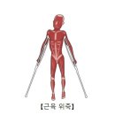 척수근육위축[Spinal muscular atrophy]뇌신경정신질환, 유전질환 이미지