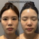 수메르뷰티 | 드레스라인] 기기관리부터 뱀부관리까지 예비신부를 위한 수성구 드레스라인 관리 수메르뷰티 솔직 후기