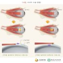 사시 수술비 특별약관(사시의 정의 및 진단확정) 이미지