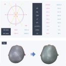 수정 | [사두증치료6] 두상교정헬멧 착용 후기4 (+비바헬멧 수정후기)