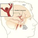 울산 뇌동맥류 이미지