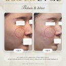 몽촌토성역 | 몽촌토성역 피부과 앞광대 필러 후기, 어려 보이는 이유는?
